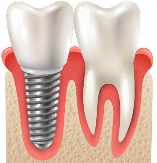 �C���v�����g