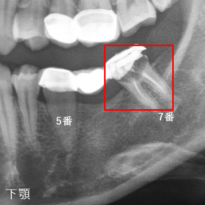 �u���b�W�̕Е�����