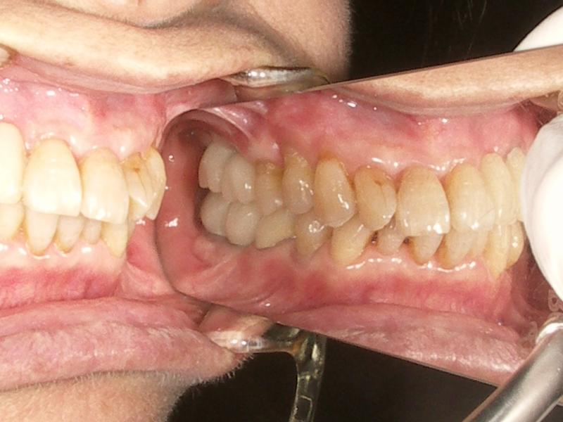 �o�[�e�B�J���X�g�b�v