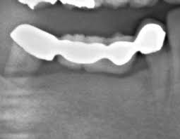 �����O�X�p���u���b�W�̃����g�Q��